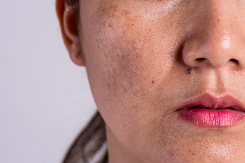 The Ordinary Melasma